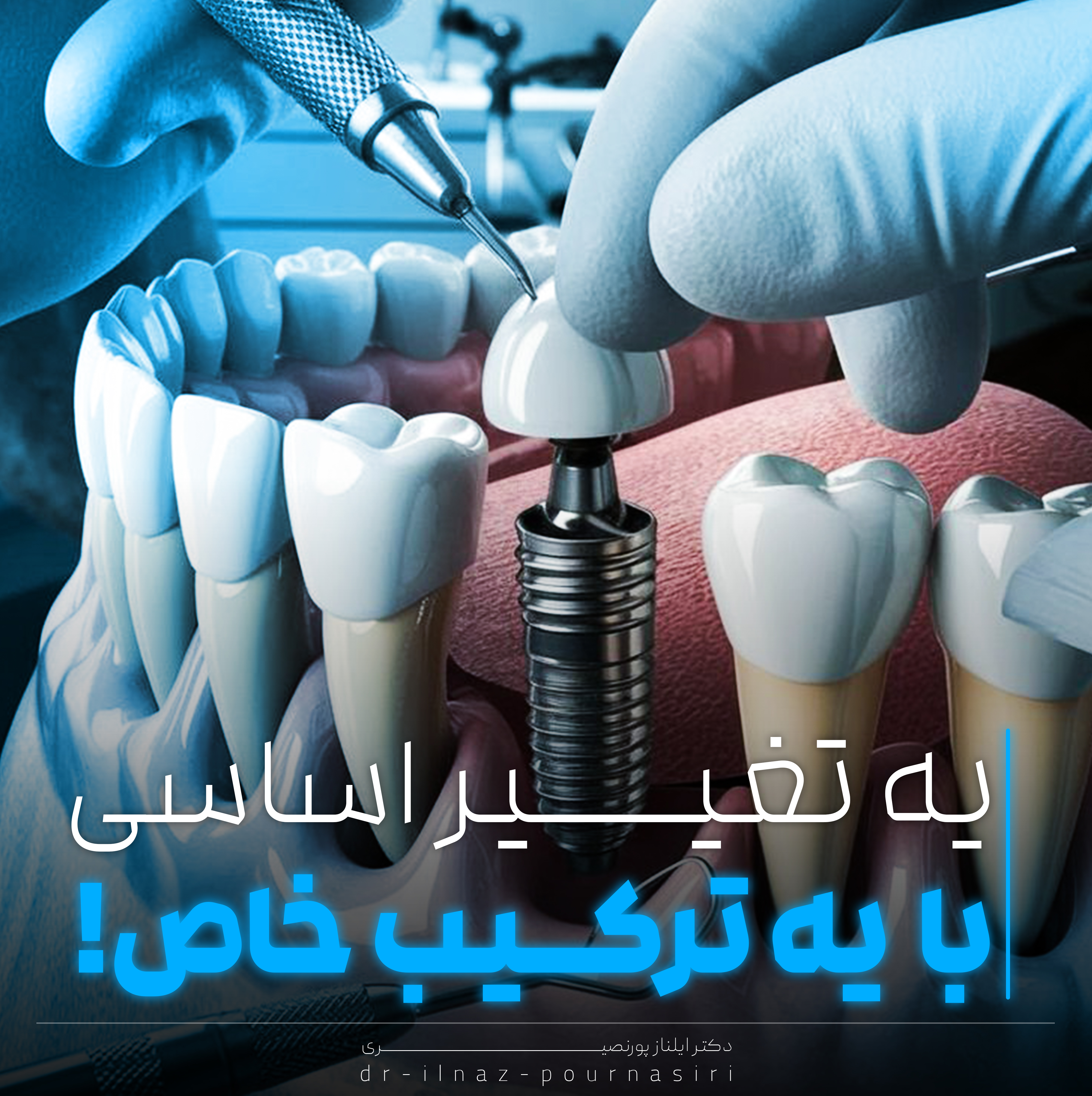 لمینت و ایمپلنت